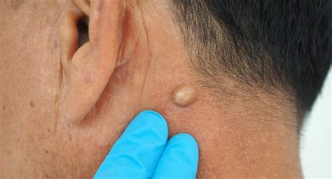 Ilustrație microscopică a unui chist sebaceu, evidențiind acumularea de keratină în interiorul unei formațiuni chistice sub derm.