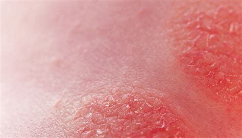 ilustrație cu diferite tipuri de erupții cutanate comune la bebeluși