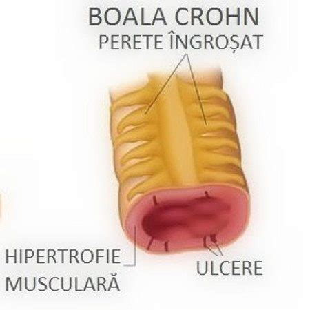 Aspect macroscopic al intestinului afectat de Boala Crohn, evidențiind îngroșarea peretelui și aspectul de „pietre de pavaj”