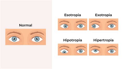 Infografic cu tipurile de strabism și imagini ilustrative.