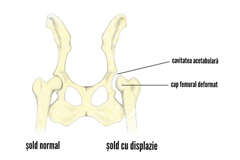 Schemă anatomică a articulației șoldului la nou-născut, evidențiind displazia