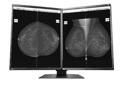 Ilustrație cu o mamografie și explicații despre importanța screening-ului.