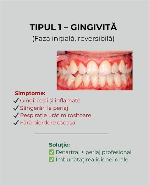 Ilustrație a gingiei inflamate (gingivită)