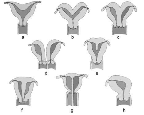 Ecografie transvaginală evidențiind uter didelf cu sac gestațional.