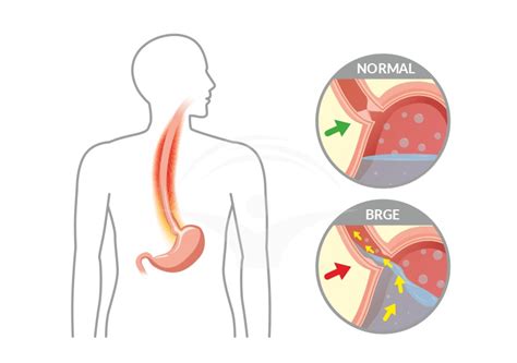 Ilustrație cu un bebeluș care prezintă semne de reflux gastroesofagian, cu o mică cantitate de lapte regurgitat.