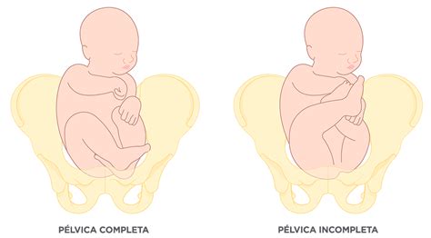 Ilustrație a celor trei tipuri de prezentatie pelviana: completa, incompleta si cu fesele in jos.