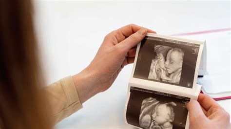 Ecografie fetală care arată poziția pelviană a bebelușului.