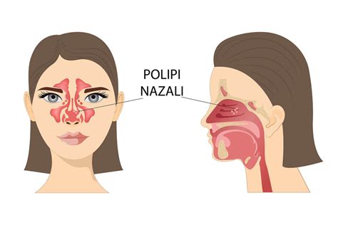 ilustrație medicală care prezintă vegetații adenoide (polipi) care blochează căile nazale