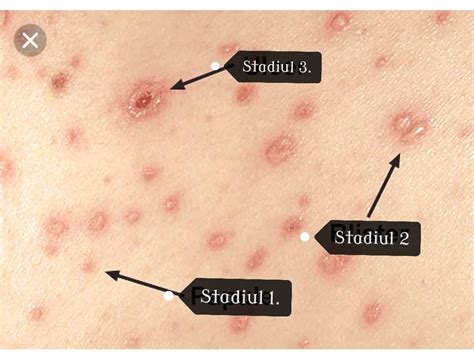 Ilustrație a erupției cutanate specifice varicelei.