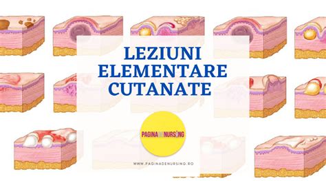 Ilustrație cu diferite tipuri de leziuni vasculare cutanate