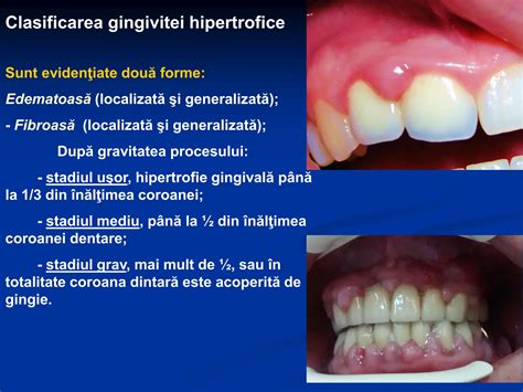 ilustrație comparativă gingie sănătoasă vs. gingie după recuperare