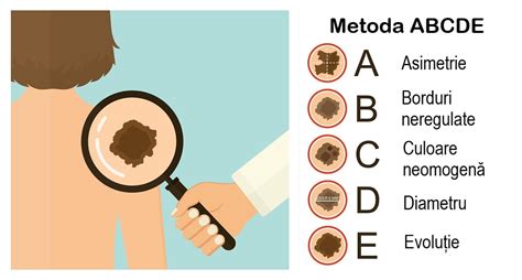 ilustrație cu diferite tipuri de alunițe, de la normale la atipice