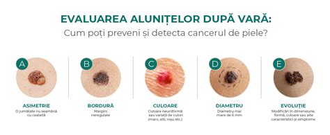 infografic cu regula ABCDE pentru evaluarea alunițelor