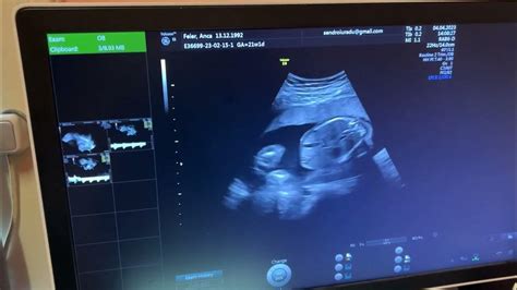 ecografie fetală de trimestru 2
