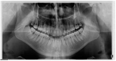 Diagramă comparativă a nivelurilor de radiații de la o radiografie dentară și alte surse