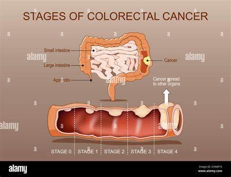 infografic incidenta cancer colo-rectal