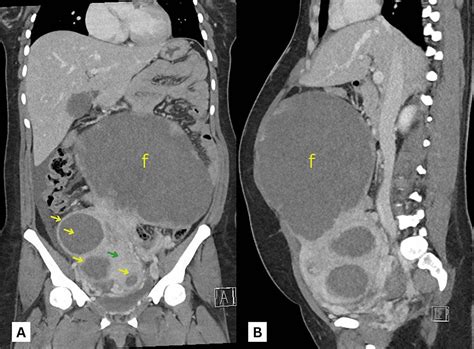 Ilustrație cu diferite tipuri de fibrom uterin (submucos, intramural, subseros)