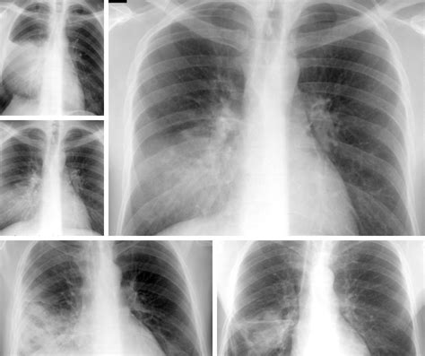 Imagine radiografie toracică ce prezintă o zonă de condensare pulmonară.
