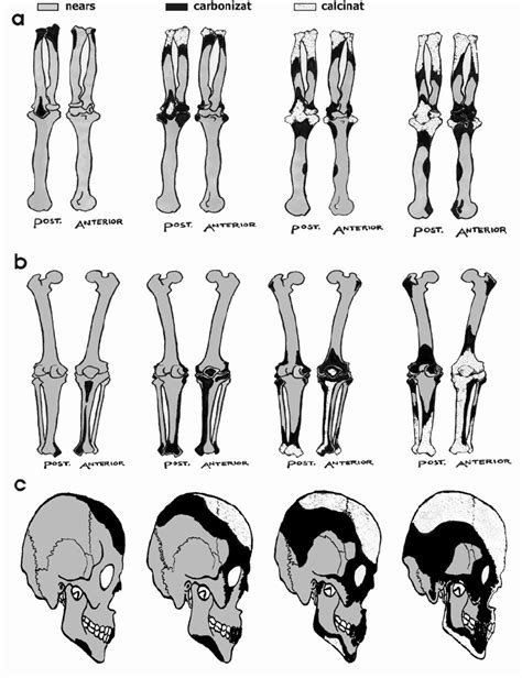 ilustratie cu zonele corpului predispuse la hiperpigmentare si vergeturi in sarcina