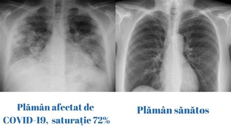 Imagine radiologică standard a unui plămân sănătos, cu indicații despre structurile vizibile.