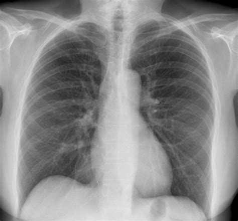 Comparație vizuală între o radiografie pulmonară normală și una cu semne de pneumonie.