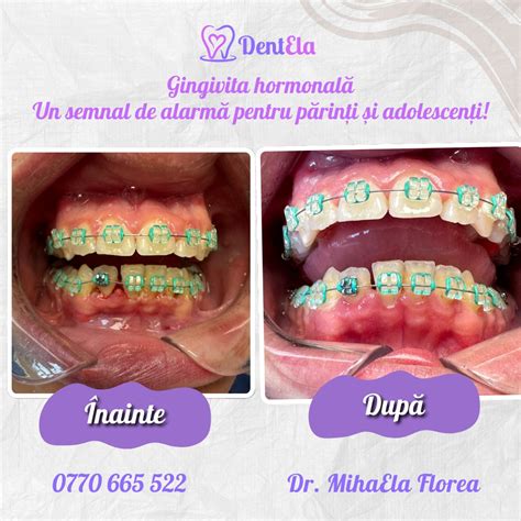 Infografic cu etapele pubertății și schimbările specifice.