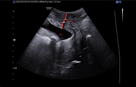 ecografie 3D a fătului în uter