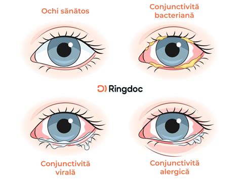 Infografic comparativ al tipurilor de meningită: bacteriană, virală, fungică, cu principalele caracteristici, cauze și contagiozitate.