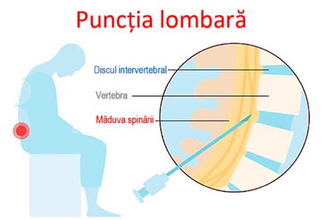 Schemă a procedurii de puncție lombară, explicând colectarea lichidului cefalorahidian pentru diagnosticarea meningitei.