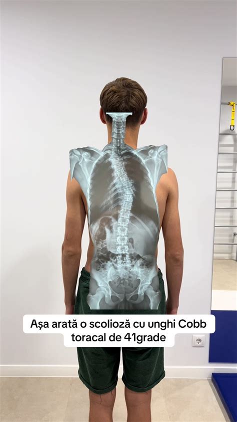 schemă a coloanei vertebrale cu semne de scolioză și o imagine cu un fizioterapeut efectuând exerciții cu un pacient