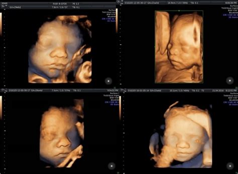 Ecografie morfologică de trimestrul 2, evidențiind anatomia fetală