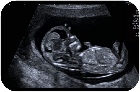 ecografie morfologica - detaliu al inimii fetale