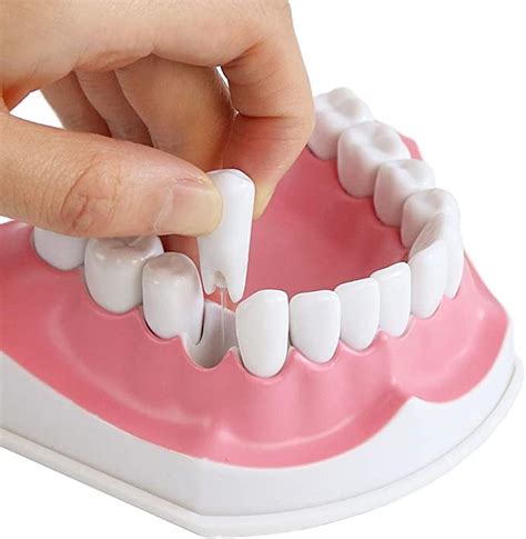 Model dentar demonstrând aplicarea unei șine de imobilizare pentru dinții mobili.