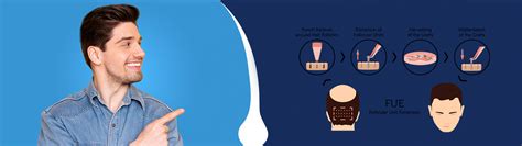 Ilustrație schematică a procedurii de transplant de păr (metoda FUE)