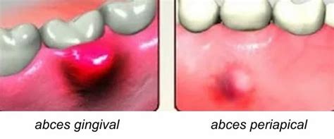 Ilustrație schematică a unui dinte cu abces periapical