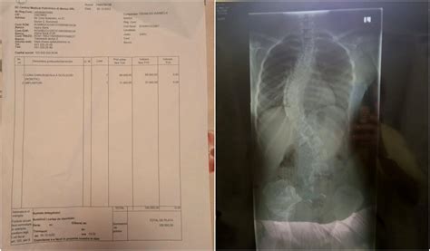 Diagramă ilustrând etapele screeningului pentru scolioză la copii