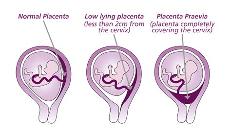 Diagramă: Poziționarea normală a placentei vs. Placenta praevia