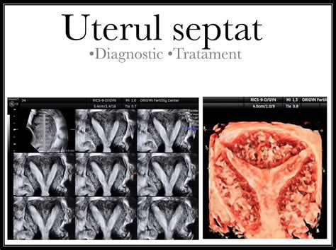 Diagramă comparativă a diferitelor tipuri de anomalii uterine congenitale (uter septat, bicorn, unicorn, didelf).