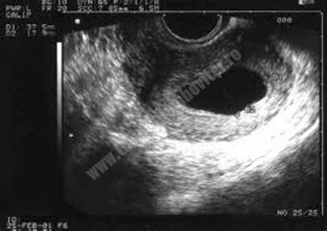 Imagine ecografică reprezentând un sac gestațional gol, fără embrion vizibil