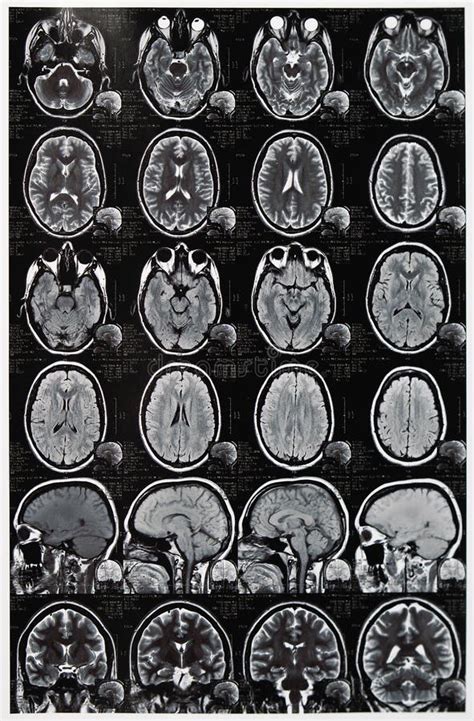 Imagine PET-CT a creierului, demonstrând activitatea metabolică