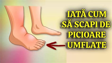 Ilustrație anatomica a picioarelor cu edem, arătând acumularea de lichid în țesuturi.