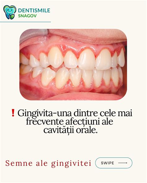 Infografic cu cele mai frecvente afecțiuni dentare la gravide: gingivita, cariile, granulomul de sarcină