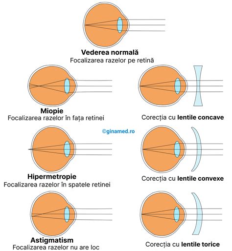Infografic cu tipurile comune de tulburări de vedere la copii, explicând pe scurt fiecare afecțiune.