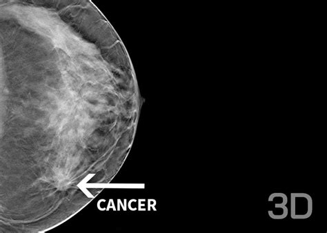 Mamografie digitală 3D cu tomosinteză pentru depistarea precoce a cancerului de sân