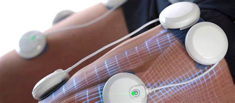 Ilustrație a aparatului de electroterapie și a modului de aplicare a electrozilor