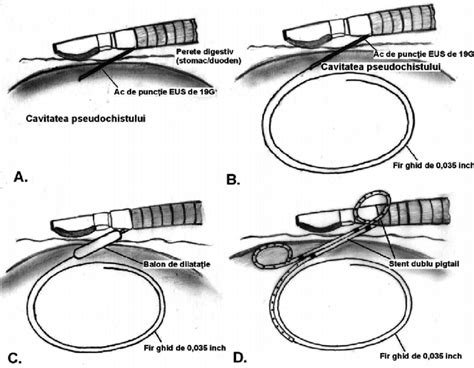 Ilustrație schematică a pieloplastiei Hynes-Anderson