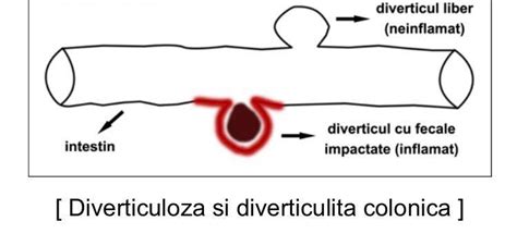 Imagine endoscopica a diverticulilor colonici