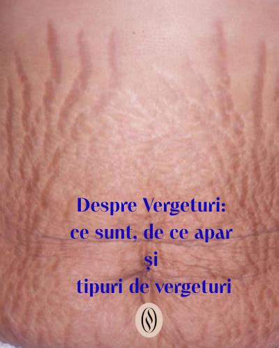 ilustrație cu diferitele tipuri de vergeturi și zonele unde apar cel mai frecvent