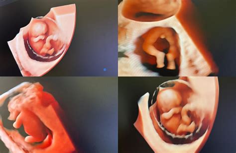 ecografie fetală detaliată care arată anatomia bebelușului la 21 de săptămâni