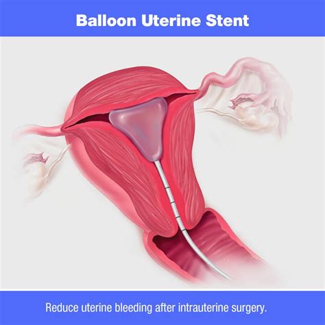 ilustrație a unui balon intrauterin (tip Bakri) introdus în uter